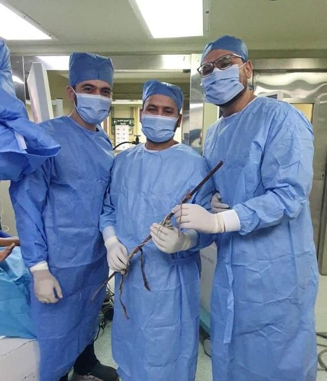 فريق طبي بطوارئ قصر العينى يضم 11 تخصصا ينجح فى إجراء جراحة خطيرة لاستخراج “سيخ معدني” من عظام الحوض لطفل