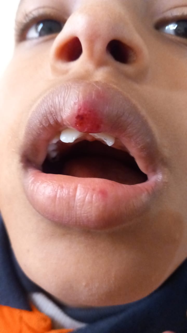 تعرض طفل بمدرسه احمد شوقي الرسميه لغات بمدينه ١٥ مايو للضرب وتكسير اسنان فكه العلوي